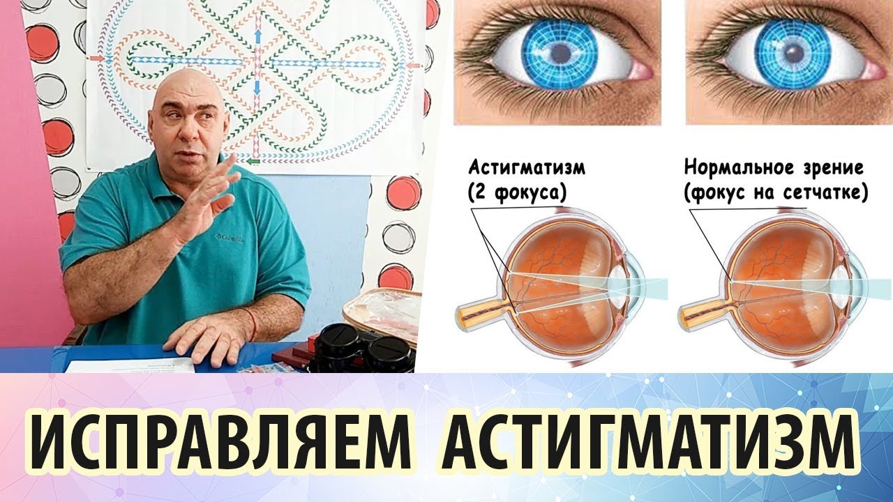 Доклад по теме Астигматизм