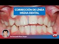 Corrección de linea media dental