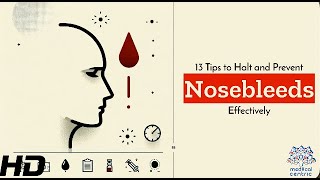 13 Life-Changing Tips to Stop Nosebleeds Before They Start!