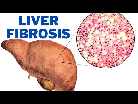 Liver Fibrosis - What are the symptoms of liver fibrosis? | 247nht