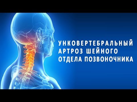 Унковертебральный (деформирующий) артроз шейного отдела позвоночника