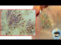 LOOKING AT A HUGE WART UNDER A MICROSCOPE!!! ***UNBELIEVABLE VIEW***