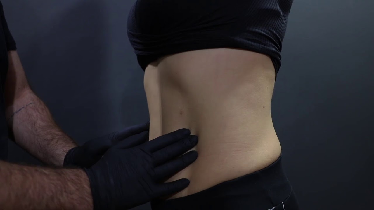 Karın germe-Tummy Tuck- Vaser liposelection