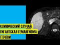 Клинический случай: гигантская гемангиома печени | МРТ-диагностика гемангиомы печени