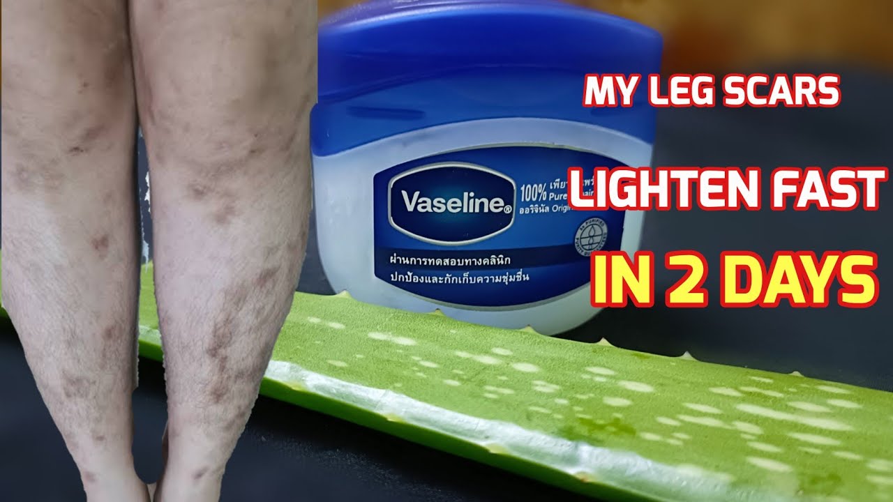 How My Leg Scars Lighten Fast In 2 Days Scarmosquito Bites On Legs