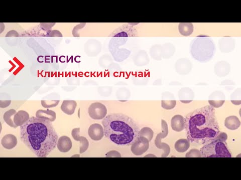 Бейне: Cbc сепсис көрсете ме?