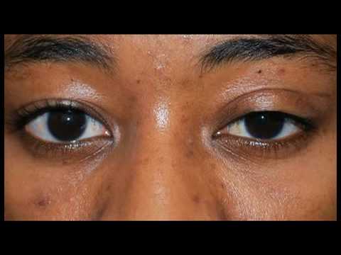 my experience having revisional ptosis surgery youtube ptosis surgery