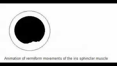 Vermiform movement of the iris spincter muscle - Adie