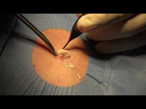 Sebaceous cyst removal