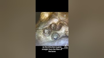 Maxillary Sinusitis Of Endodontic Origin (MSEO)