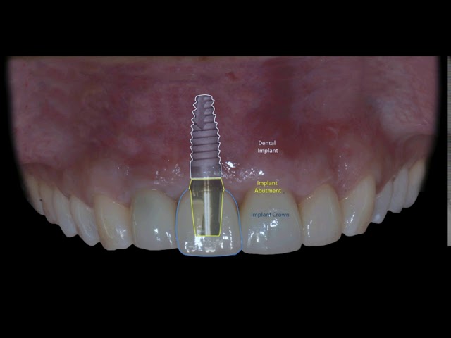 What does a Dental Implant look like? | Implant Specialist Team Milton Oakville Mississauga Toronto