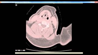 CT Airway Anatomy screenshot 5