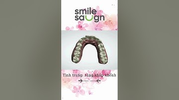 Phác đồ điều chỉnh răng khấp khểnh - SmileSalign