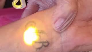Обучение лазерное удаление татуажа, татуировок, перманентного макияжа от Академия 21