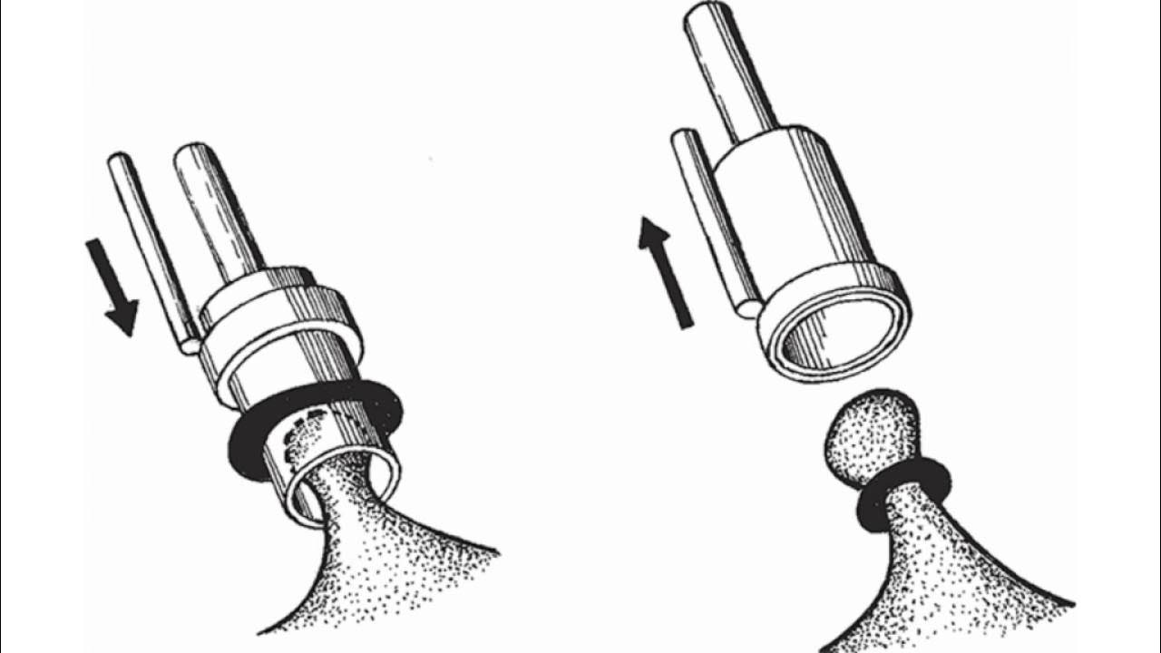 латексное лигирование геморроя