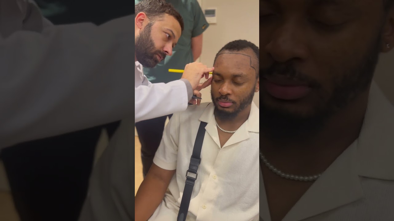 Afro Hairline Design by Dr Caymaz