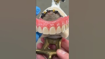 4-Locator Hybrid #Denture #dental #teeth #smile #lsk121shorts @EnvisiontecMain #envisiontec