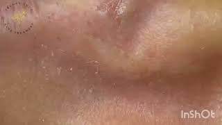 new pimple popping videos blackheads 2023 7