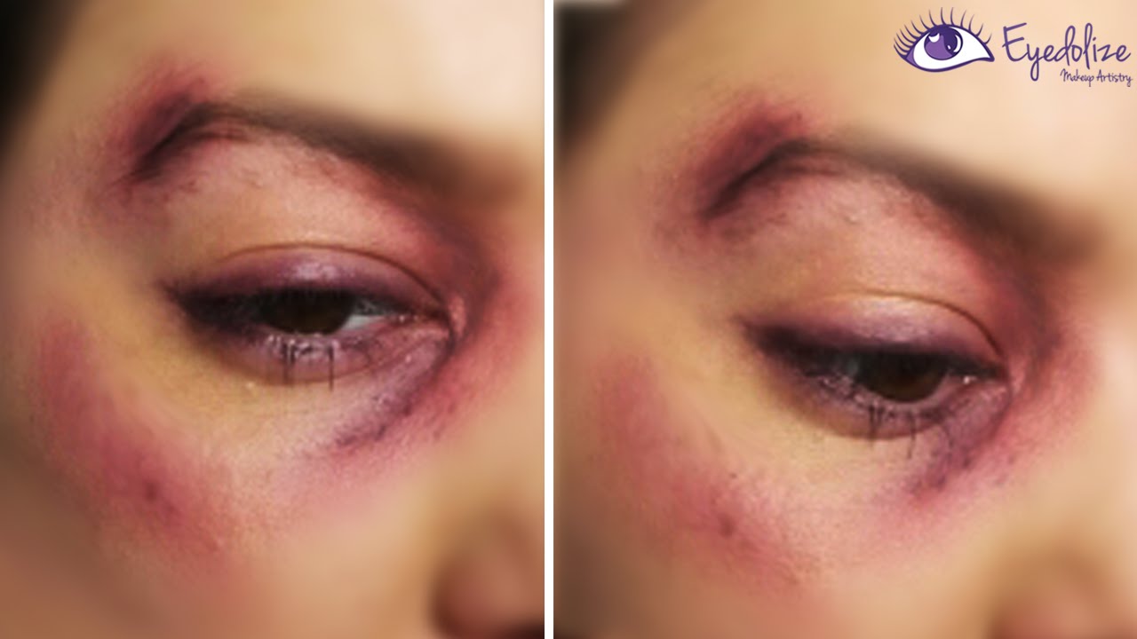 I Got Punched Bruised Black Eye Makeup Tutorial By EyedolizeMakeup