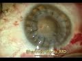 Cornea transplantation surgery.  Shannon Wong, MD 10-2013.