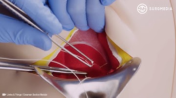 Bringing Simulation to Life: Teaching Surgical Skills in Obstetrics Using a C Section Simulator