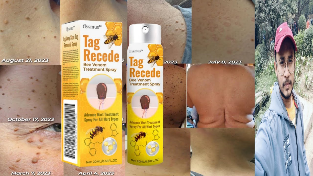 Tag Recede Bee Venom Treatment Spray Reviews Flysmus Tag Recede Bee Venom Treatment Spray | Honest Review - YouTube