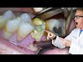 Badly infected tooth extraction procedure with pus coming out of the tooth