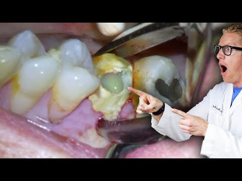 Wideo: Czy zainfekowany ząb musi zostać wyrwany?