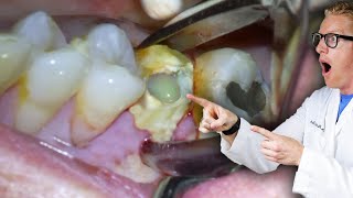 Badly Infected Tooth Extraction Procedure With Pus Coming Out of The Tooth! screenshot 5