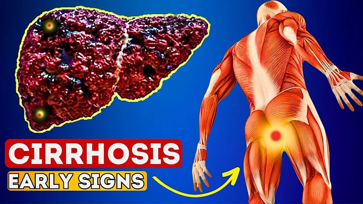 12 Early Signs of Liver CIRRHOSIS | LIVER is DYING! - DayDayNews