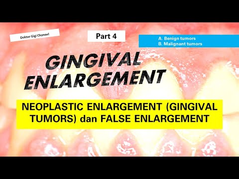 Video: Pada gingivitis epitel sulkular?