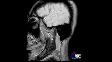 Dynamic MRI of temporomandibular( TMJ )ening movement of jaw @dvanced_mri #radiology #mandible