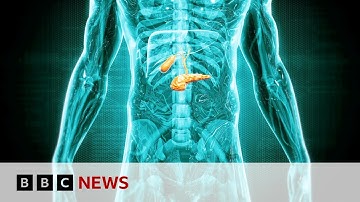 Detecting ‘hidden’ pancreatic cancer cases | BBC News