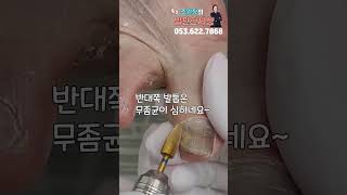 무좀발톱 방치는  #shorts #대구내성발톱  #대구무좀 #대구발톱 #ingrown #toenails