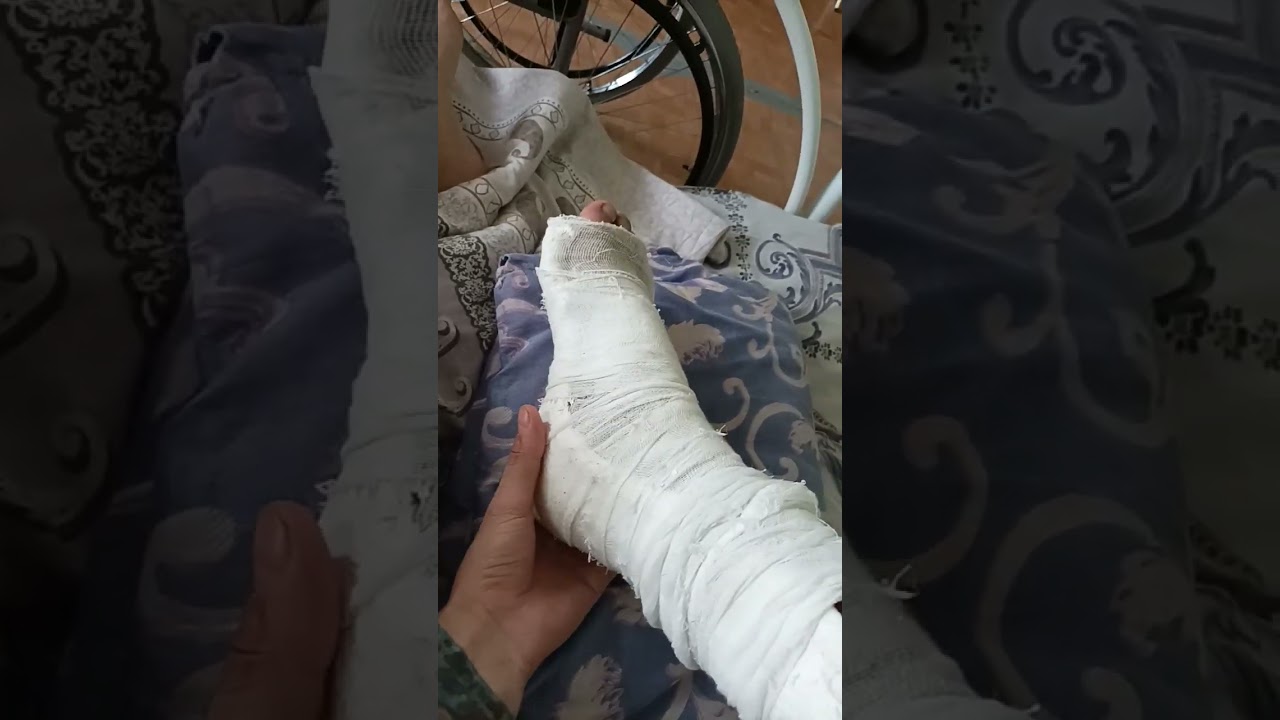 #перелом пятки#сломана пяточная кость# сломал пятку#сколько заживает кость#сломана пятка