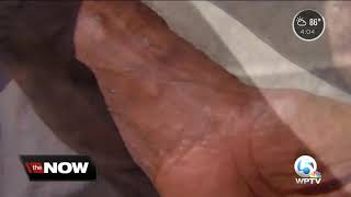 Bed bug dispute at senior living apartment