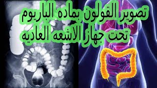 BARIUM ENEMA  طرق تشخيص الامساك باشعه الصبغه