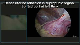 Laparoscopic appendectomy with adhesiolysis for post-cesarian adhesions