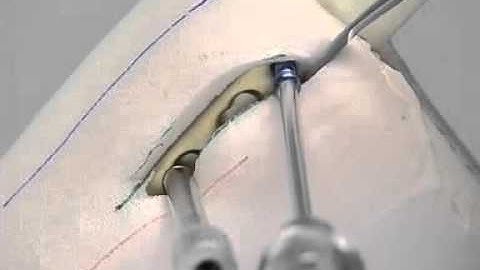 AO locking compression plate LCP