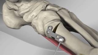 First Metatarsal Proximal Opening Wedge Osteotomy with Arthrex® LPS POW Plate screenshot 5