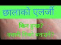 Skin allergy in Nepali |Dr Prajwal Pandey(Dermatologist)|doctor sathi