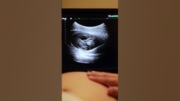 12 Weeks Pregnancy Ultrasound Scan 👶 | Baby Growth Inside Womb #shorts #fetus #pregnant