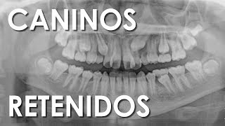 Ortodoncia En Caninos Retenidos Caninos Incluidos