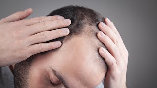 Birth Mark And Hair Transplantation