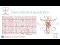 Como calcular el eje eléctrico del QRS