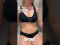 Amazing result only a week out of a Reversed Max Tuck®️ 🥇#awaketummytuck