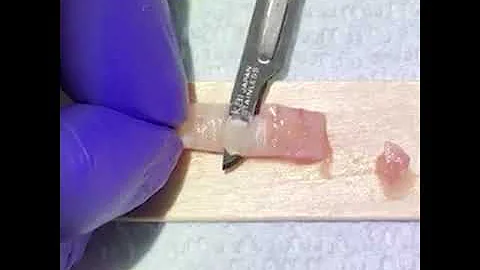 de epithelialized free gingival graft