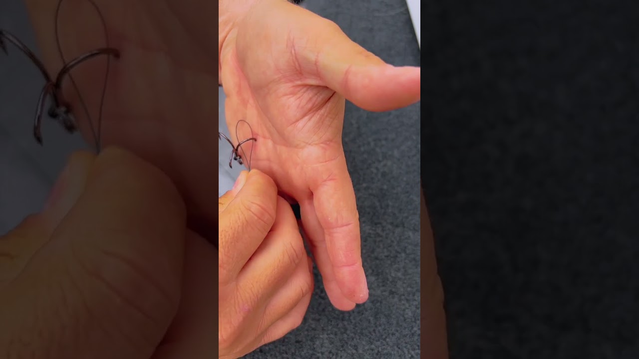 How To Remove A Hook (Deep In The Hand) #shorts 