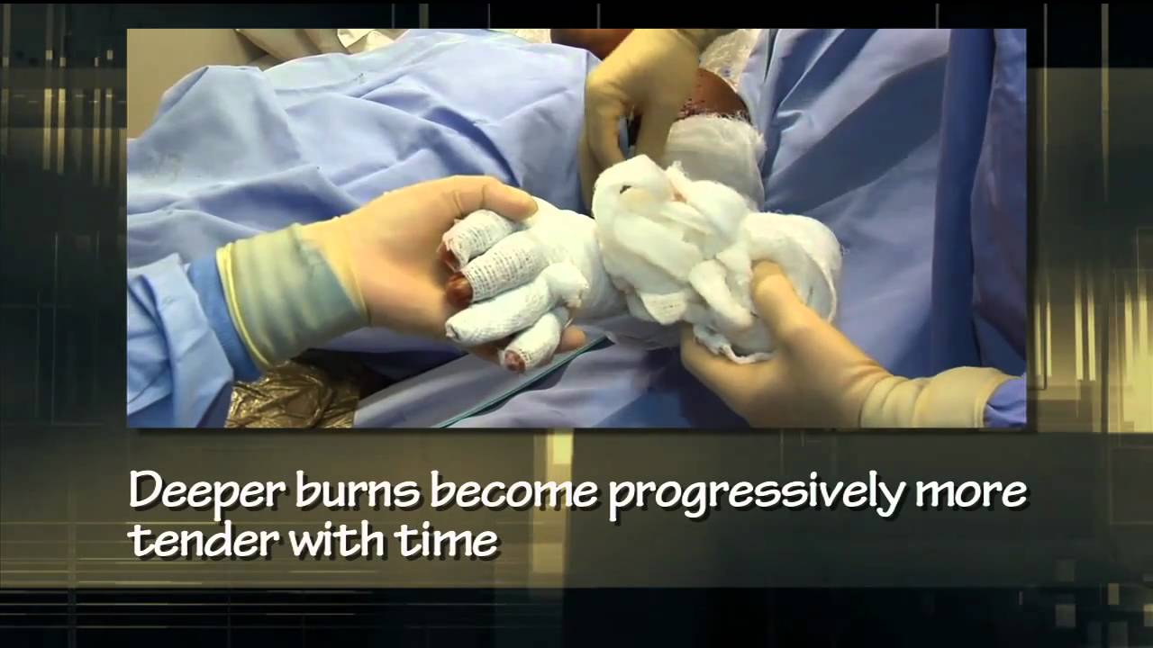 Burn Center Wound CareUF Department of Surgery YouTube