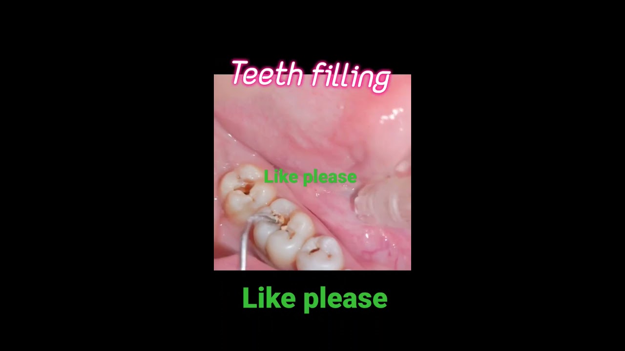 Teeth Filling Cavity Video
